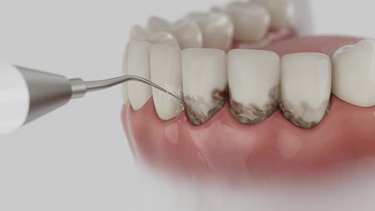 Trusted Wisdom Tooth Removal service in Wayzata, MN - Dentist Open Now